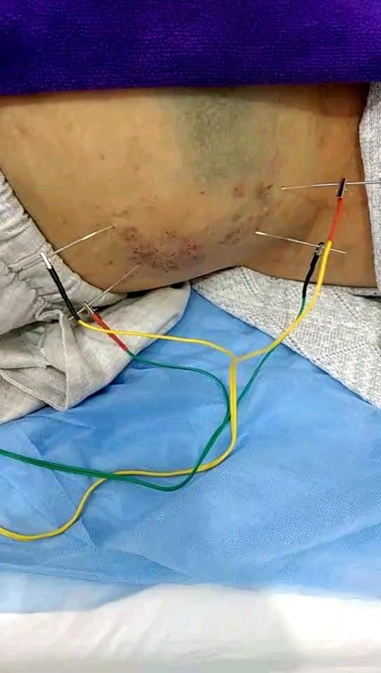 专业的中医针灸推拿康复理疗师 通过艾灸火灸