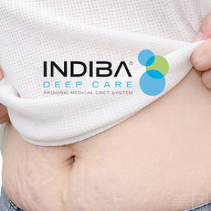 INDIBA孕期生长纹淡化